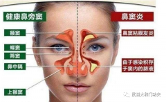 武當派《太和門》秘傳《鼻炎養生導引術